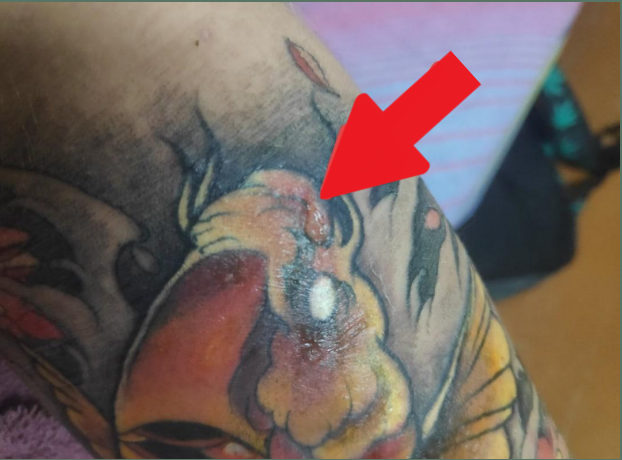 Осложнения после татуировки